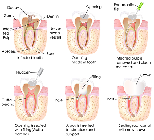 Mission District Root Canals