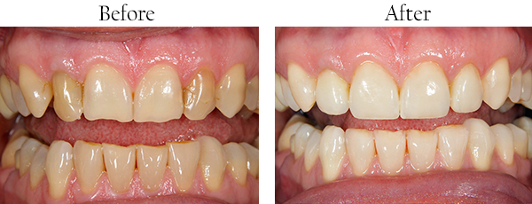 Mission District Before and After Dental Implants