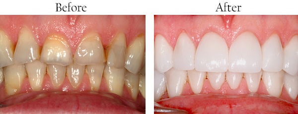 Noe Valley Before and After Teeth Whitening
