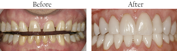 Mission District Before and After Invisalign